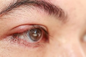 Điều trị u bã đậu ở mi mắt