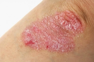 Điều trị vảy nến trên bệnh nhân HIV