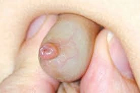 Điều trị viêm bao quy đầu