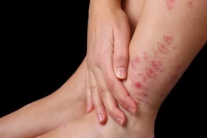 Điều trị viêm da cơ địa thế nào?