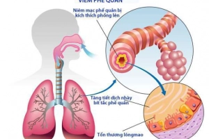 Điều trị viêm phế quản mãn tính như thế nào?