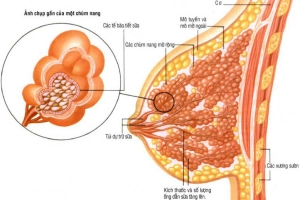Điều trị xơ nang tuyến vú