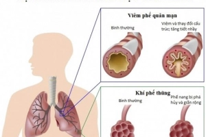 Đợt cấp bệnh phổi tắc nghẽn mạn tính