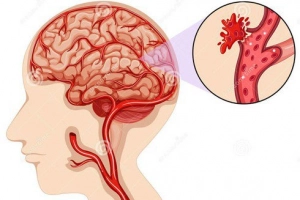 Đột quỵ vùng thân não: Những điều cần biết