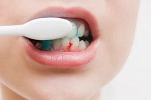 Đừng chủ quan nếu thường xuyên bị chảy máu khi đánh răng