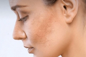 Dùng retinol bị sạm da phải làm sao?