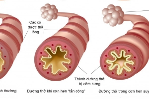 Gây mê bị co thắt phế quản do nguyên nhân gì?