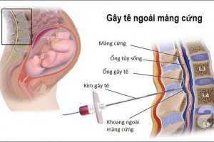 Gây tê ngoài màng cứng có tác dụng gì?