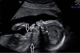 Giải đáp các thắc mắc về bướu giáp thai nhi - fetal goitre