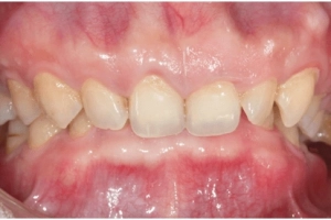 Giải pháp điều trị răng bị thụt vào trong
