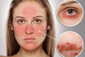 Giảm triệu chứng và biến chứng của lupus ban đỏ