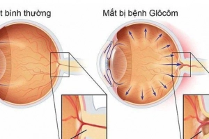 Glocom góc mở có thể laser chữa tật khúc xạ được không?