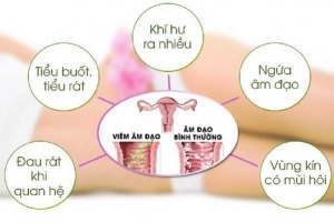 Gợi ý cách phòng tránh viêm phụ khoa cho chị em