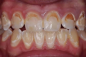 Hậu quả khi răng thiếu canxi