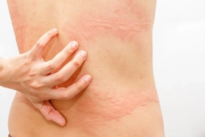 Hay ngứa dị ứng nổi mề đay phải làm sao?