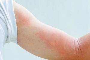 Hay nổi mẩn đỏ ngứa là dấu hiệu bệnh gì?
