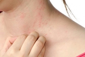 Herpes da và vẩy nến gây mẩn ngứa, nên dùng kem dưỡng thế nào?