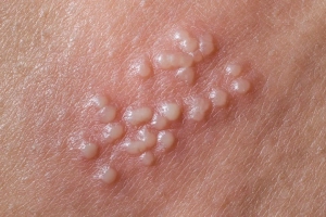 Herpes sinh dục: Hình ảnh, triệu chứng và điều trị