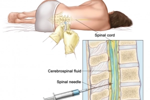 Hiểu đúng về đau lưng sau gây tê tủy sống