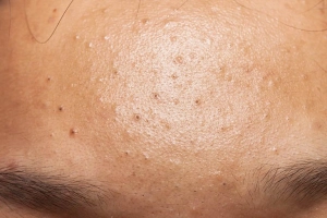 Hiểu về mụn đầu đen và mụn đầu trắng