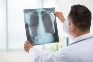 Hình ảnh dải xơ đỉnh phổi trên Xquang phổi nghĩa là gì?