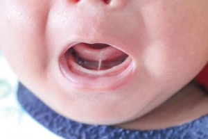 Hình ảnh lưỡi bình thường của trẻ sơ sinh