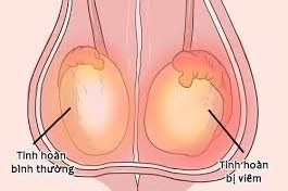 Hình ảnh viêm tinh hoàn có dễ phân biệt?
