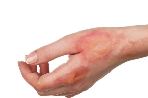 Hoại tử thượng bì nhiễm độc là bệnh gì?