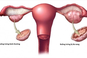 Hội chứng buồng trứng đa nang gây ra vấn đề gì?