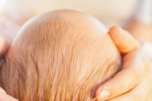 Hội chứng đầu phẳng ở trẻ em