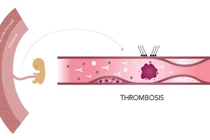 Hội chứng kháng Phospholipid (APS) với phụ nữ mang thai