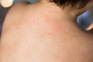 Hội chứng phát ban nhiễm trùng