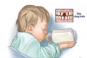 Hội chứng sâu răng do bú bình