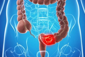 Hội chứng ung thư đại trực tràng di truyền không do polyp (HNPCC)