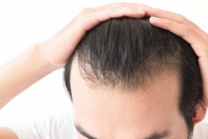 Hói đầu bẩm sinh có thể cấy tóc không?