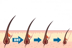 Hormone Dihydrotestosterone là gì?