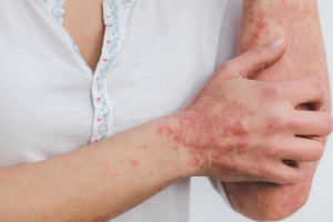 Hướng dẫn chăm sóc người bị vẩy nến trong thời tiết ấm áp