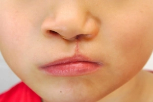 Hướng dẫn chăm sóc trẻ có khe hở môi, vòm miệng