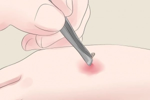 Hướng dẫn sơ cứu ong đốt