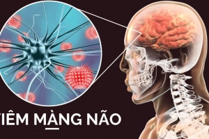 Hướng dẫn trực quan về bệnh viêm màng não