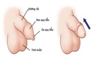 Hướng dẫn vệ sinh bao quy đầu cho trẻ sơ sinh