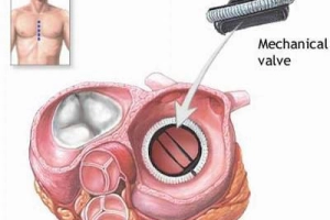 Khả năng hồi phục của người bệnh tai biến mạch máu não có cao không?