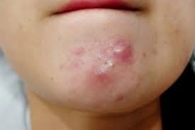 Khắc phục mụn sưng viêm ở tuổi dậy thì như thế nào?