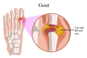 Khám sức khỏe tổng quát có phát hiện sớm bệnh gout