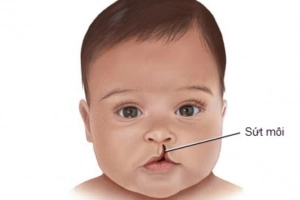 Khe hở môi hàm trên thường gặp bên nào?