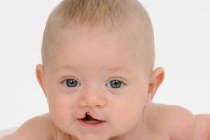 Khe hở môi, vòm miệng ở trẻ: Vì sao không nên phẫu thuật quá sớm?