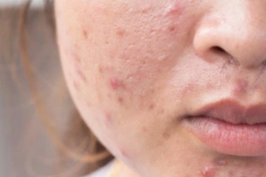 Khi có mụn trứng cá nên làm gì?