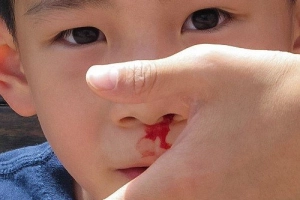Khi nào chảy máu mũi ở trẻ em là nghiêm trọng?