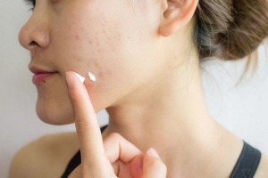 Khi nào nên dùng thuốc trị mụn nội tiết?