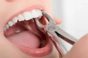 Khi nào phải nhổ răng vĩnh viễn? Có ảnh hưởng gì không?
